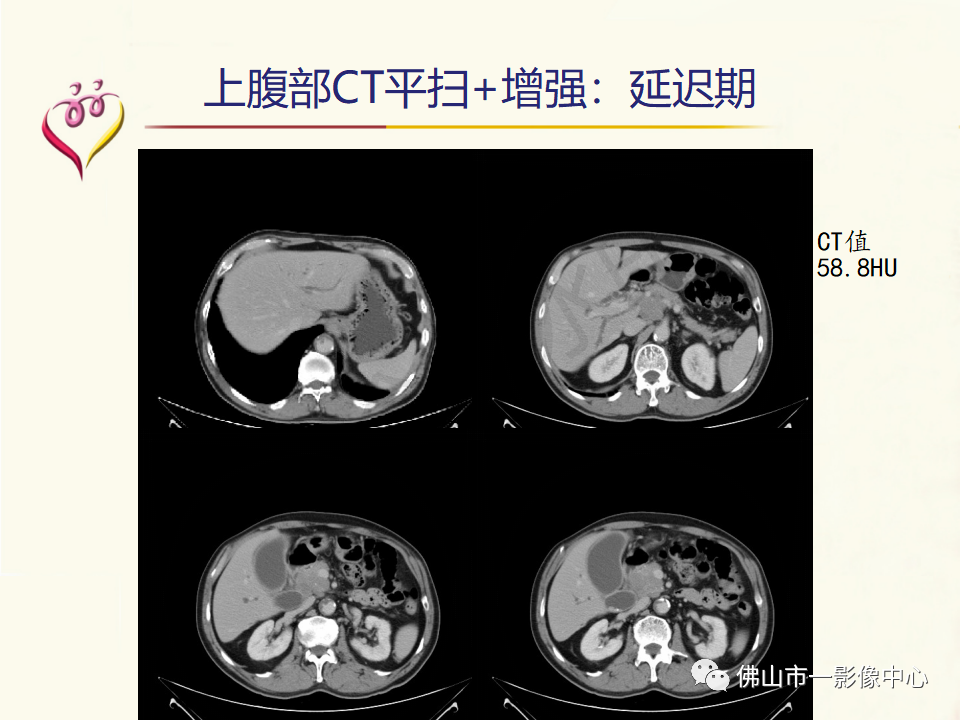 影像PPT - 【病例】胰腺淋巴瘤1例CT及MR影像-7