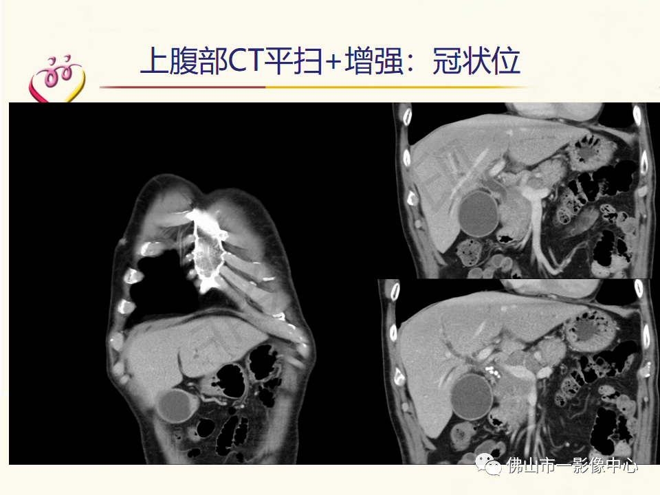影像PPT - 【病例】胰腺淋巴瘤1例CT及MR影像-8