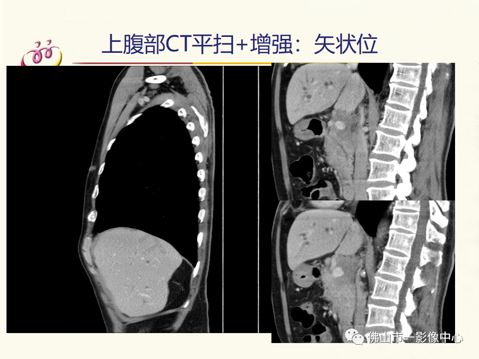 影像PPT - 【病例】胰腺淋巴瘤1例CT及MR影像-9