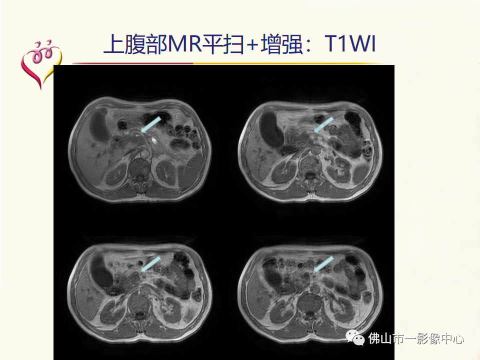 影像PPT - 【病例】胰腺淋巴瘤1例CT及MR影像-10
