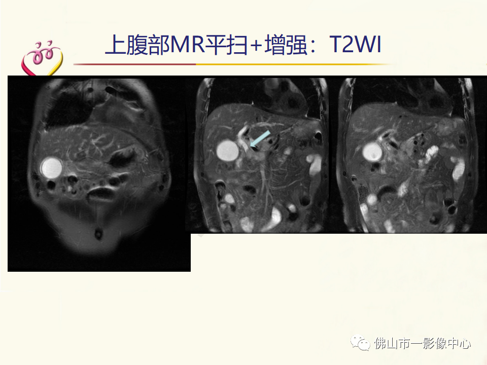 影像PPT - 【病例】胰腺淋巴瘤1例CT及MR影像-11