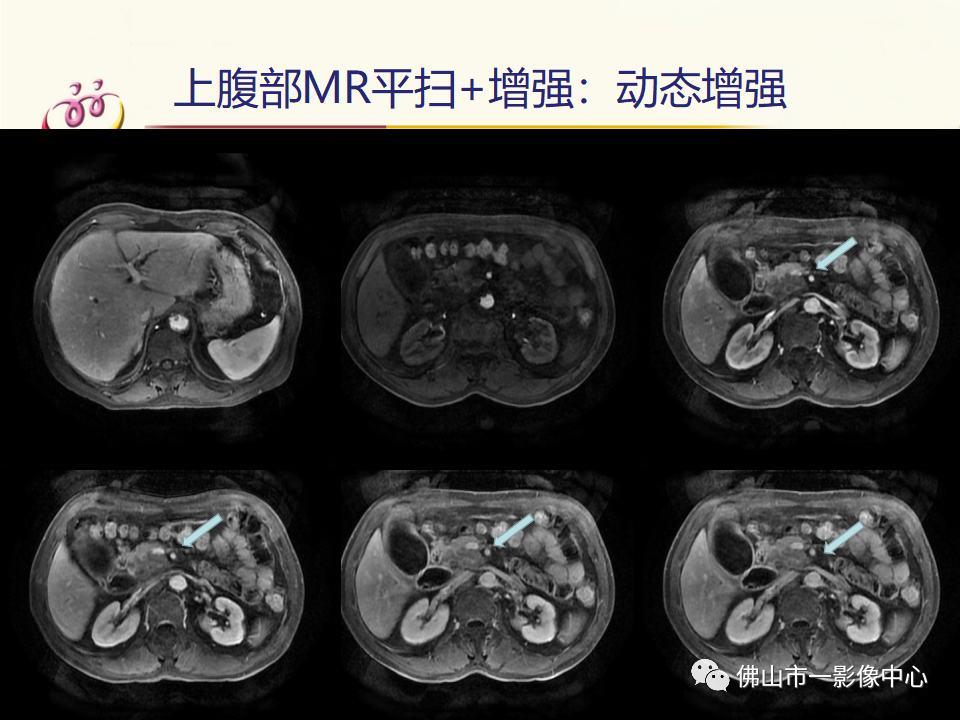 影像PPT - 【病例】胰腺淋巴瘤1例CT及MR影像-13