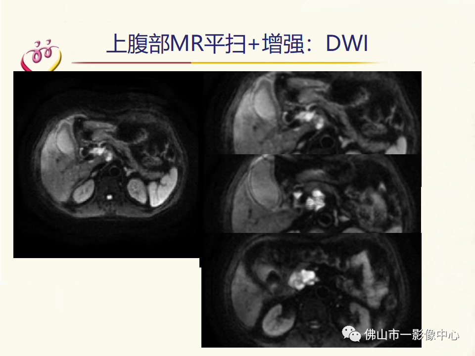 影像PPT - 【病例】胰腺淋巴瘤1例CT及MR影像-14