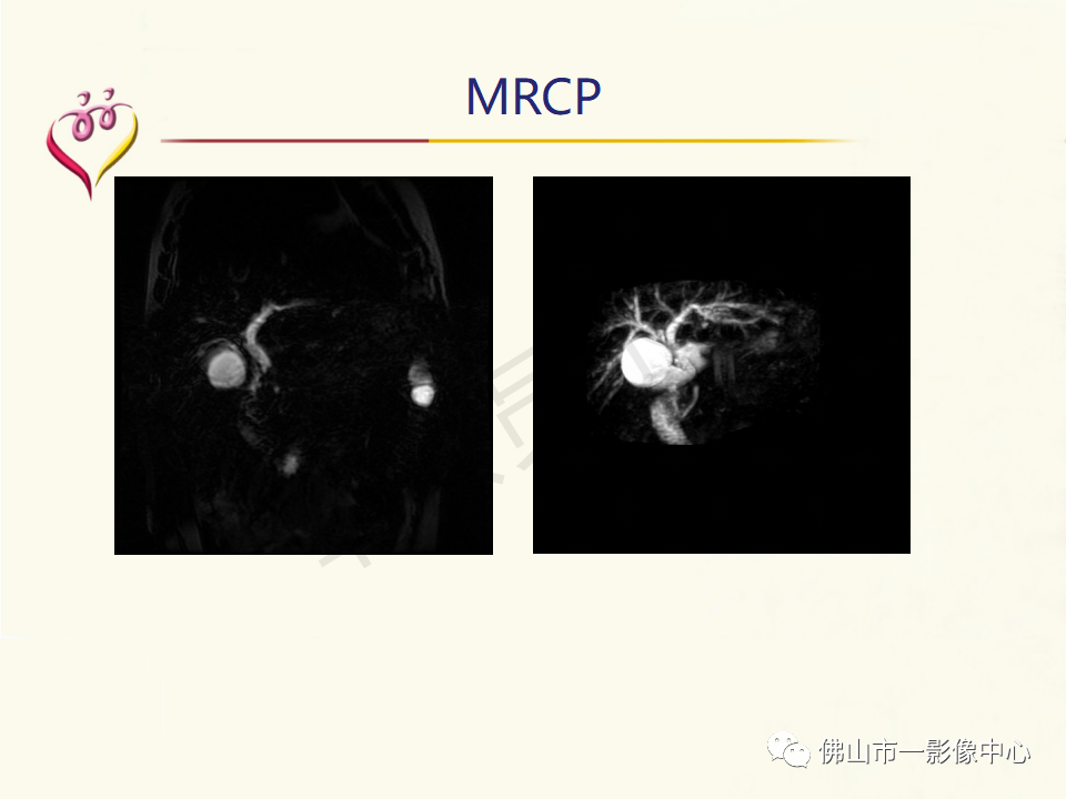 影像PPT - 【病例】胰腺淋巴瘤1例CT及MR影像-15