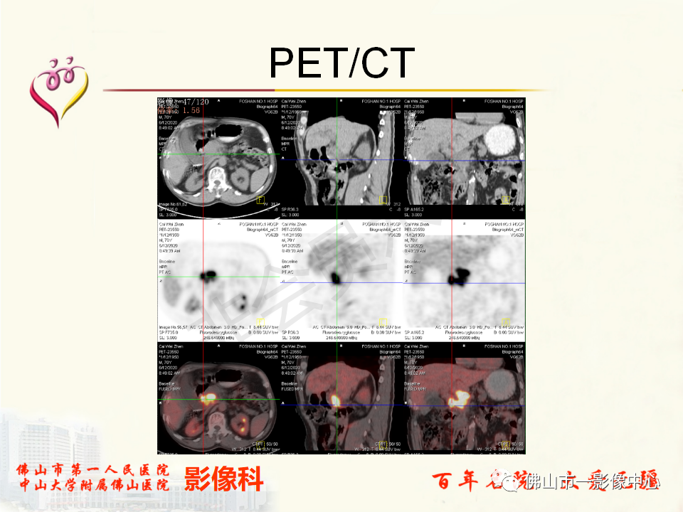 影像PPT - 【病例】胰腺淋巴瘤1例CT及MR影像-16