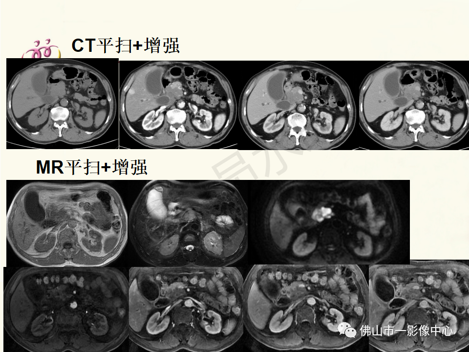 影像PPT - 【病例】胰腺淋巴瘤1例CT及MR影像-17