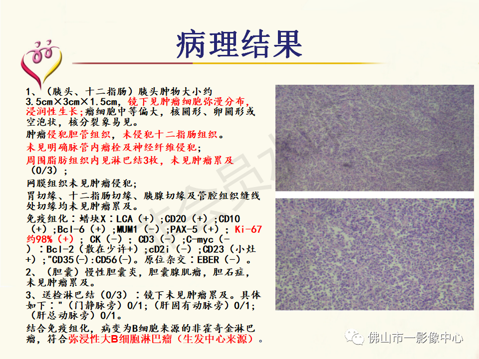 影像PPT - 【病例】胰腺淋巴瘤1例CT及MR影像-21