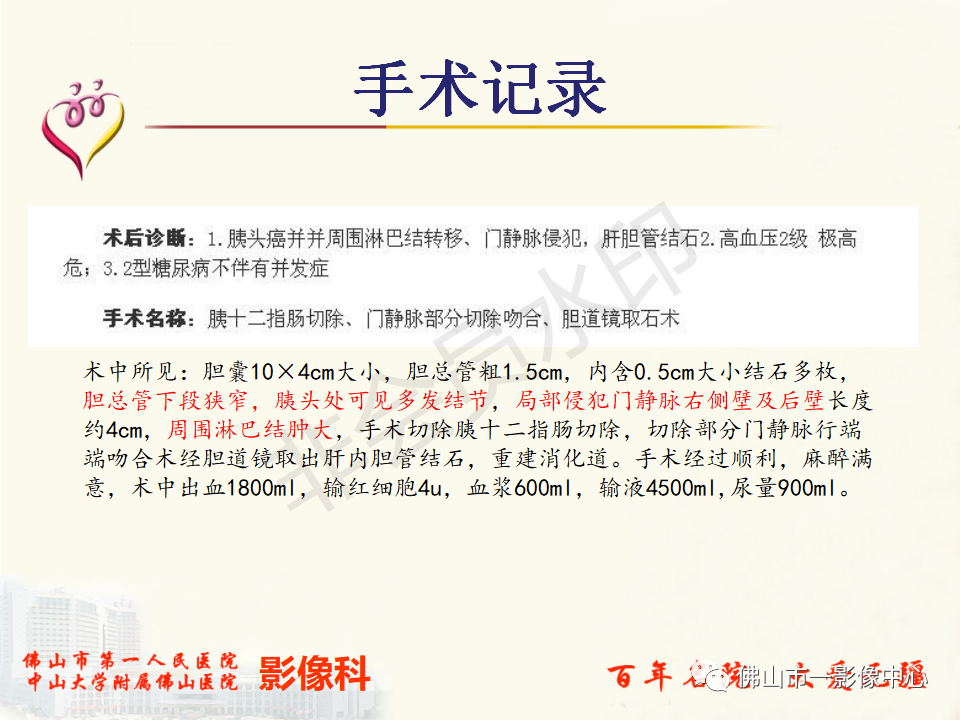 影像PPT - 【病例】胰腺淋巴瘤1例CT及MR影像-20