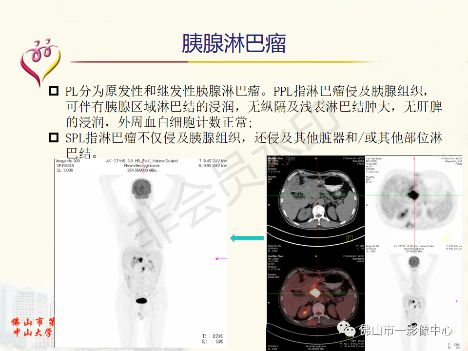 影像PPT - 【病例】胰腺淋巴瘤1例CT及MR影像-24
