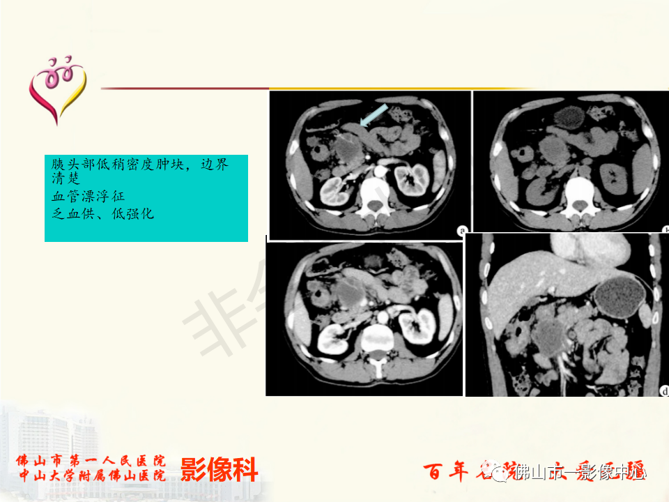影像PPT - 【病例】胰腺淋巴瘤1例CT及MR影像-27