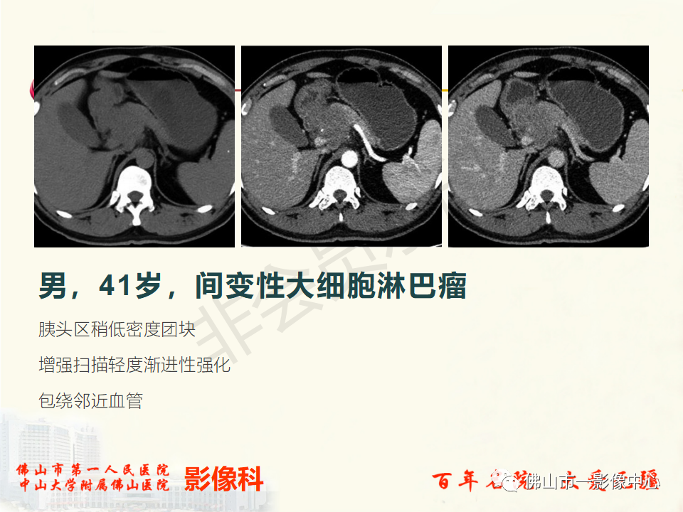 影像PPT - 【病例】胰腺淋巴瘤1例CT及MR影像-28