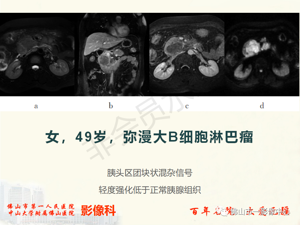 影像PPT - 【病例】胰腺淋巴瘤1例CT及MR影像-29