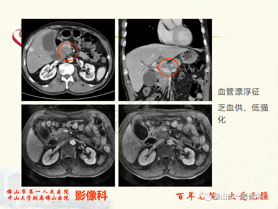 影像PPT - 【病例】胰腺淋巴瘤1例CT及MR影像-30