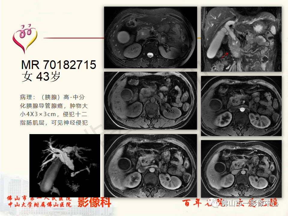 影像PPT - 【病例】胰腺淋巴瘤1例CT及MR影像-34