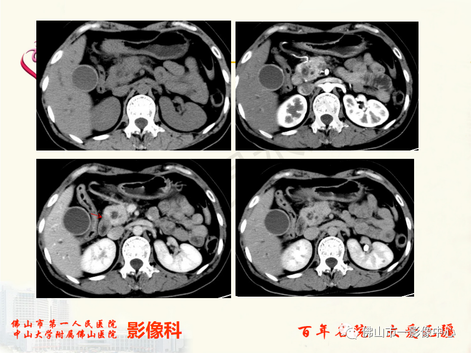 影像PPT - 【病例】胰腺淋巴瘤1例CT及MR影像-35