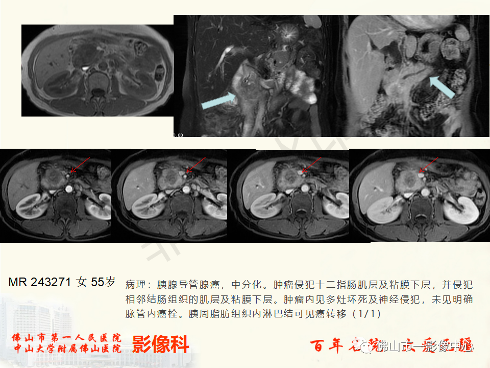 影像PPT - 【病例】胰腺淋巴瘤1例CT及MR影像-36