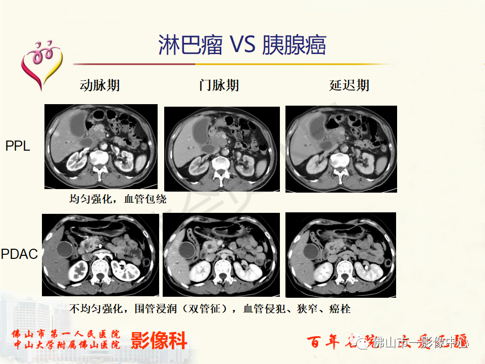 影像PPT - 【病例】胰腺淋巴瘤1例CT及MR影像-37