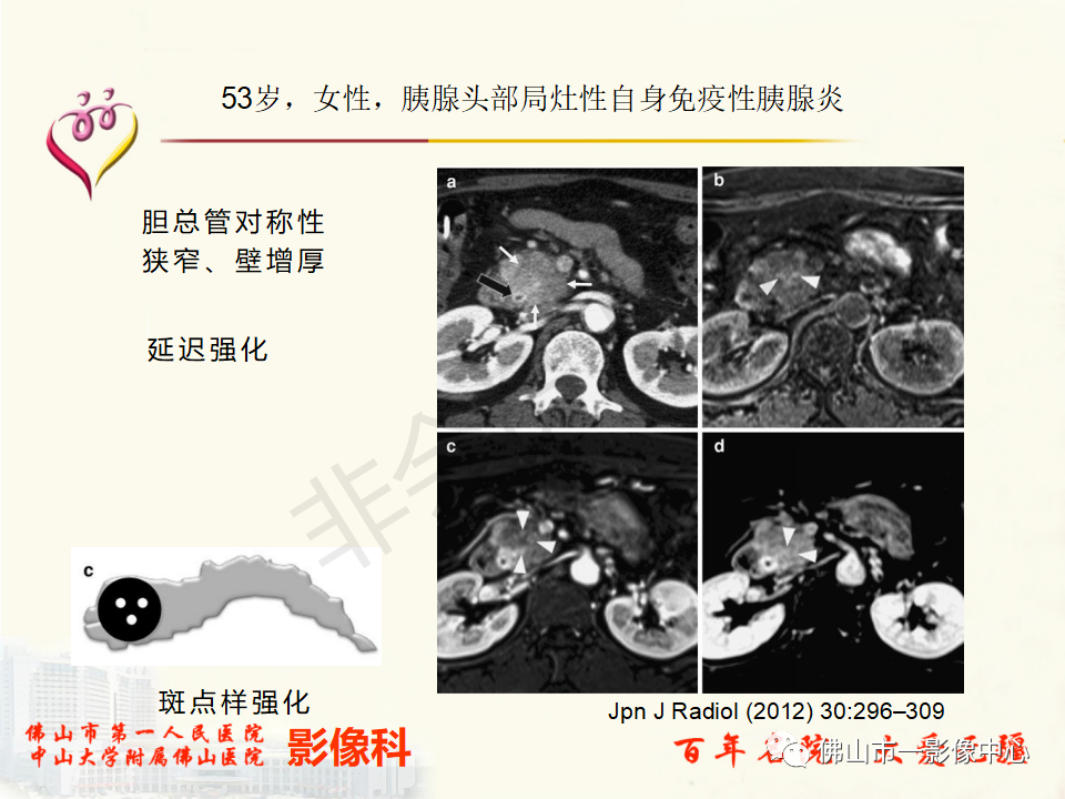 影像PPT - 【病例】胰腺淋巴瘤1例CT及MR影像-40