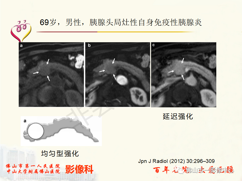 影像PPT - 【病例】胰腺淋巴瘤1例CT及MR影像-41