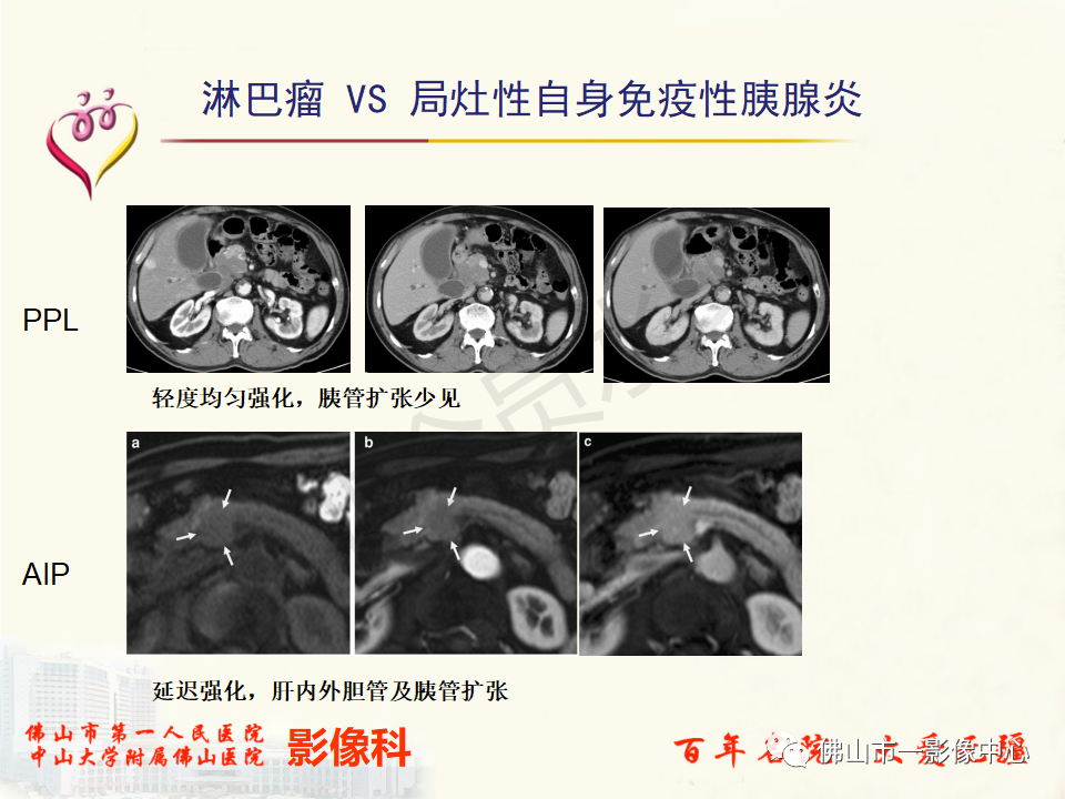 影像PPT - 【病例】胰腺淋巴瘤1例CT及MR影像-42