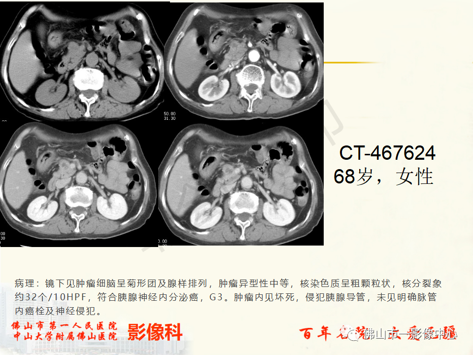 影像PPT - 【病例】胰腺淋巴瘤1例CT及MR影像-45