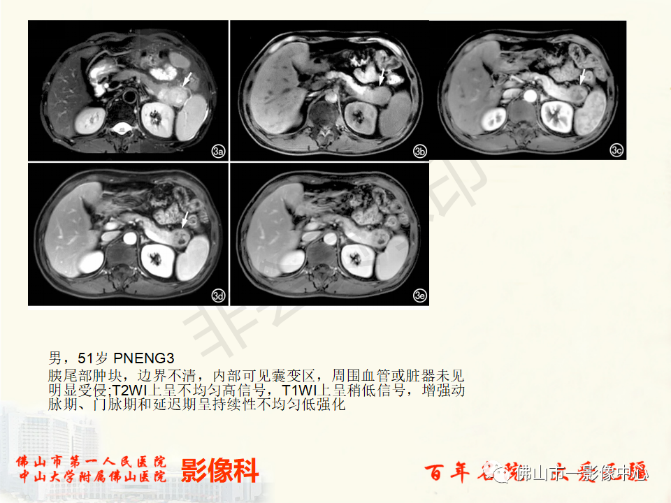 影像PPT - 【病例】胰腺淋巴瘤1例CT及MR影像-46