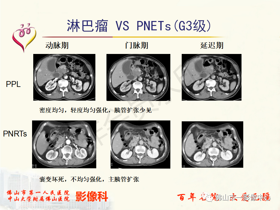 影像PPT - 【病例】胰腺淋巴瘤1例CT及MR影像-47
