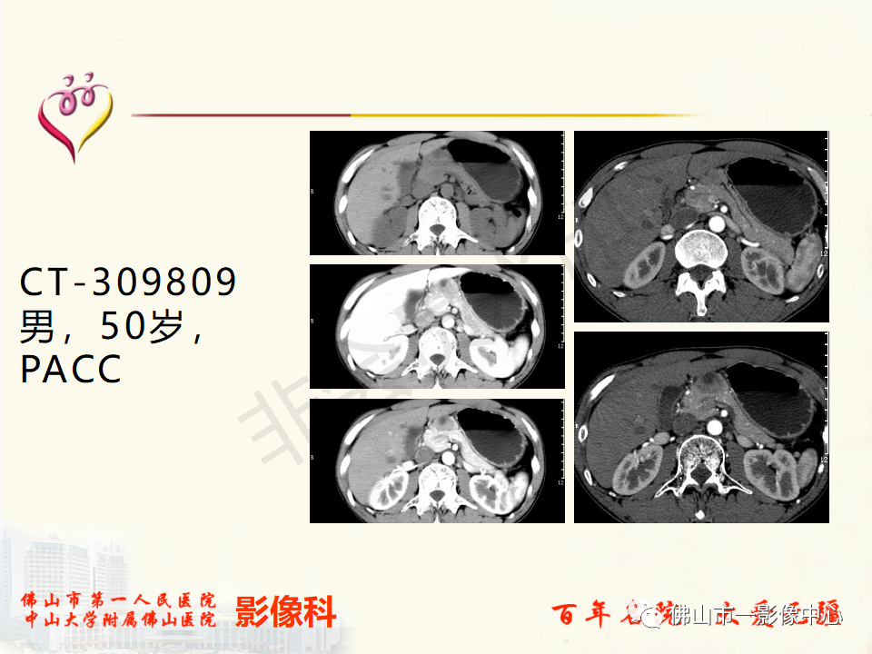 影像PPT - 【病例】胰腺淋巴瘤1例CT及MR影像-50