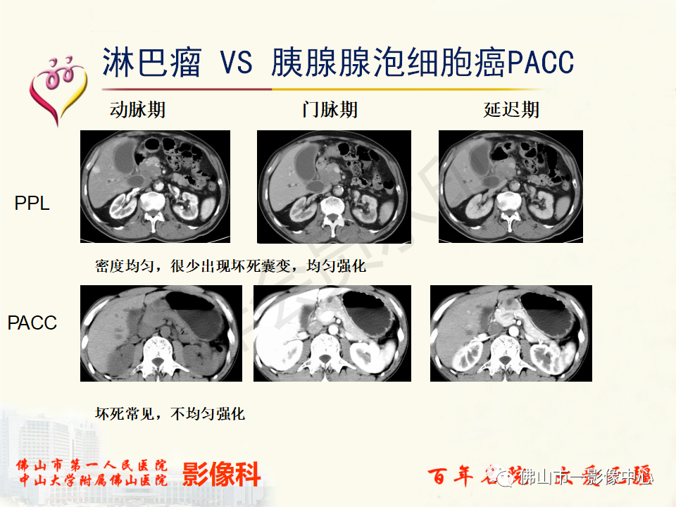 影像PPT - 【病例】胰腺淋巴瘤1例CT及MR影像-51