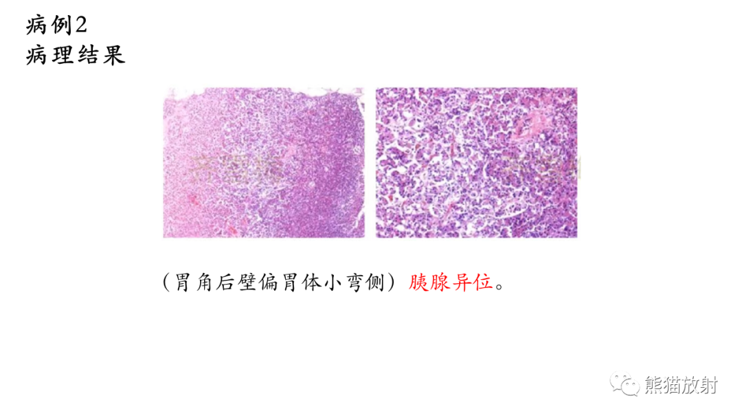 影像PPT - 【病例】胃壁结节异位胰腺 VS 胃肠道间质瘤-12