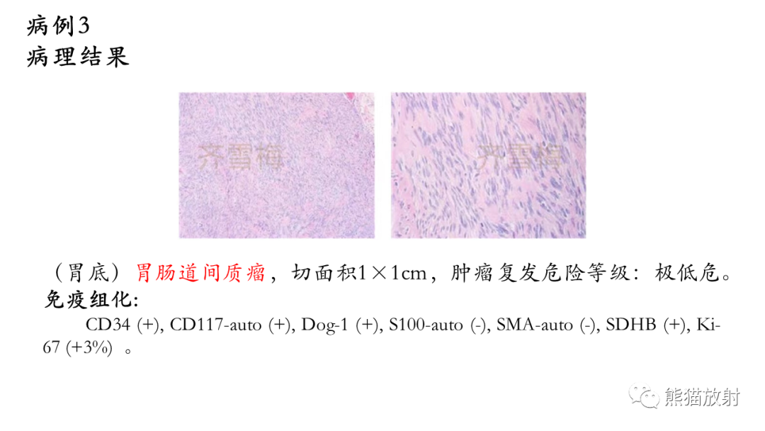 影像PPT - 【病例】胃壁结节异位胰腺 VS 胃肠道间质瘤-14