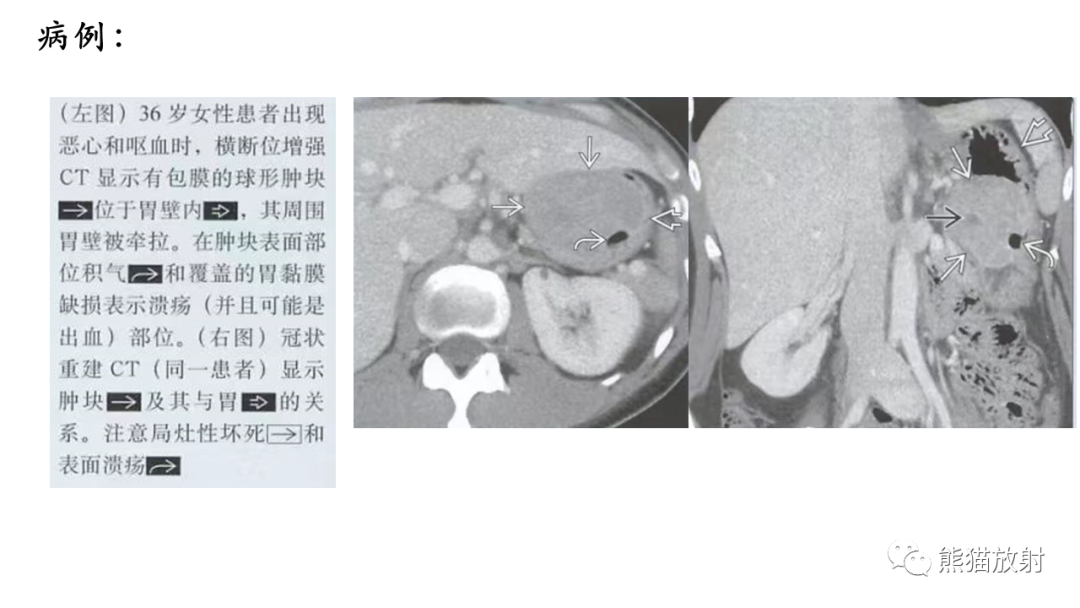 影像PPT - 【病例】胃壁结节异位胰腺 VS 胃肠道间质瘤-26