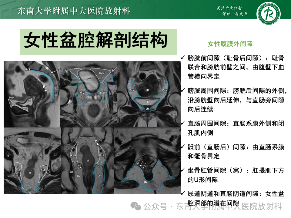 影像PPT - 【PPT】女性盆腔内腹膜外占位性病变-5