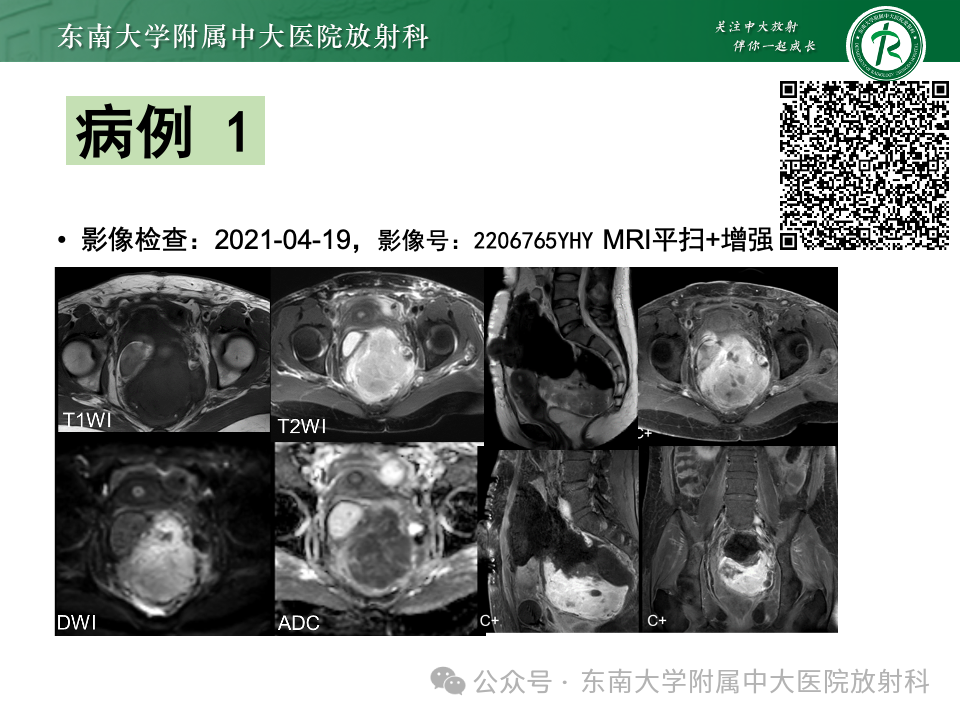 影像PPT - 【PPT】女性盆腔内腹膜外占位性病变-11