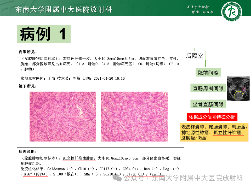 影像PPT - 【PPT】女性盆腔内腹膜外占位性病变-12