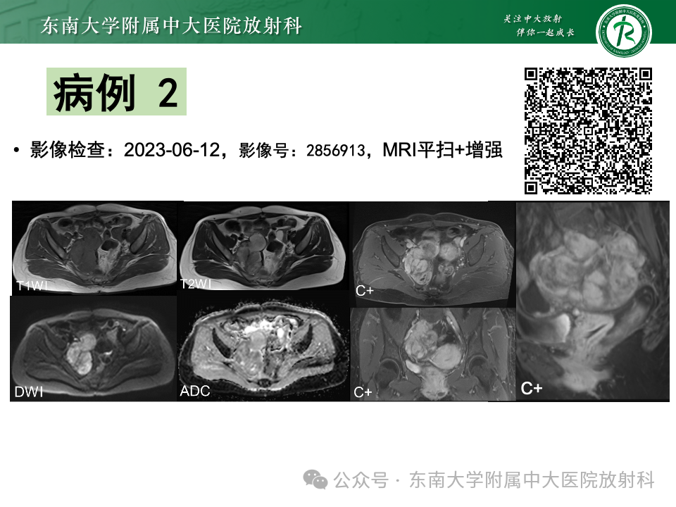 影像PPT - 【PPT】女性盆腔内腹膜外占位性病变-15