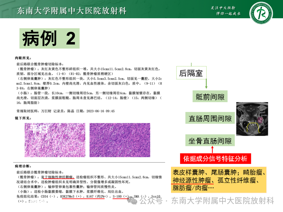 影像PPT - 【PPT】女性盆腔内腹膜外占位性病变-17
