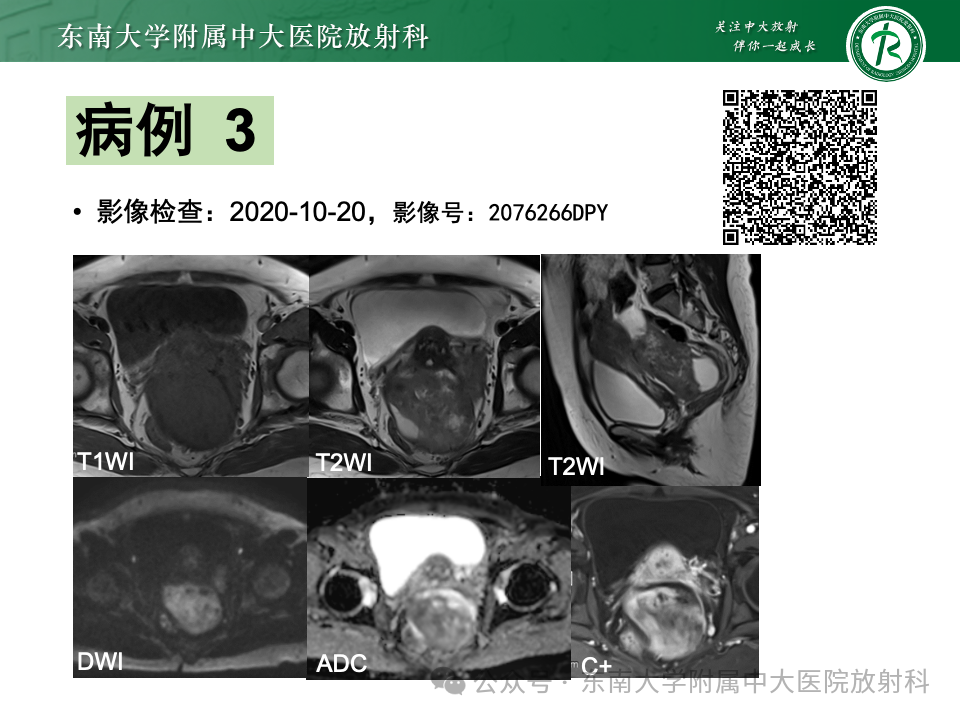 影像PPT - 【PPT】女性盆腔内腹膜外占位性病变-19