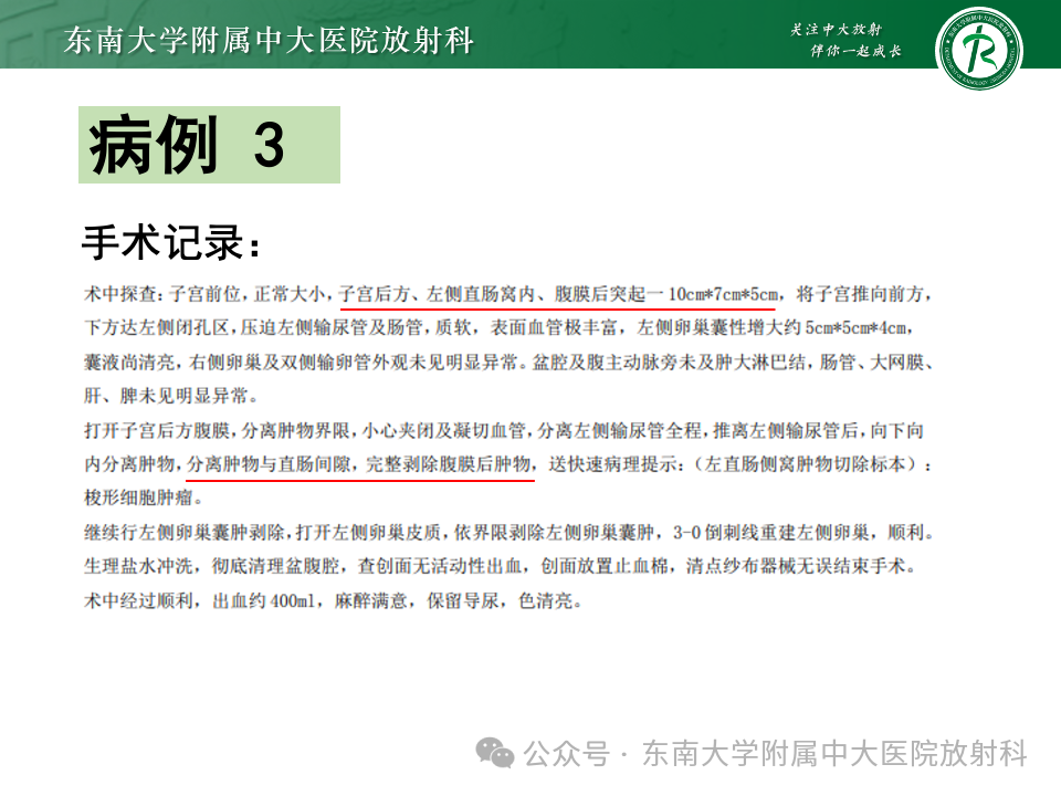 影像PPT - 【PPT】女性盆腔内腹膜外占位性病变-20