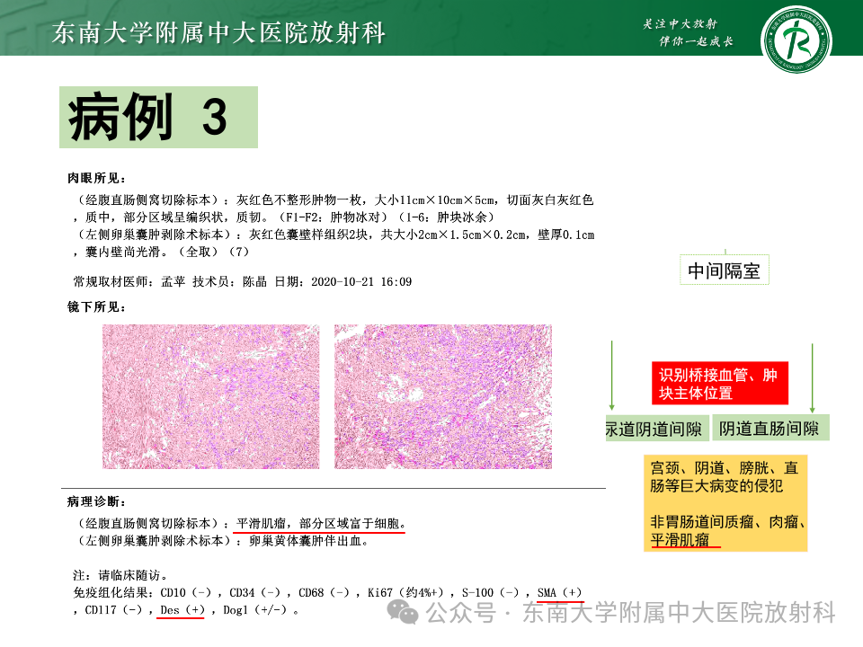 影像PPT - 【PPT】女性盆腔内腹膜外占位性病变-21