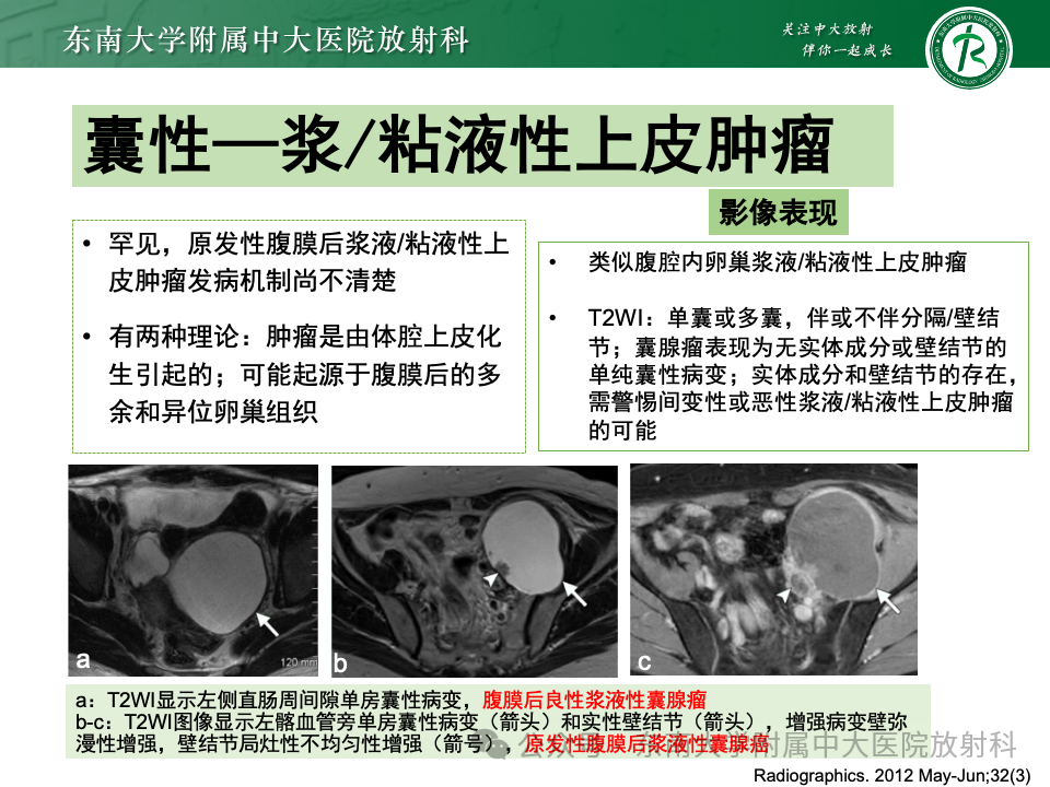 影像PPT - 【PPT】女性盆腔内腹膜外占位性病变-24