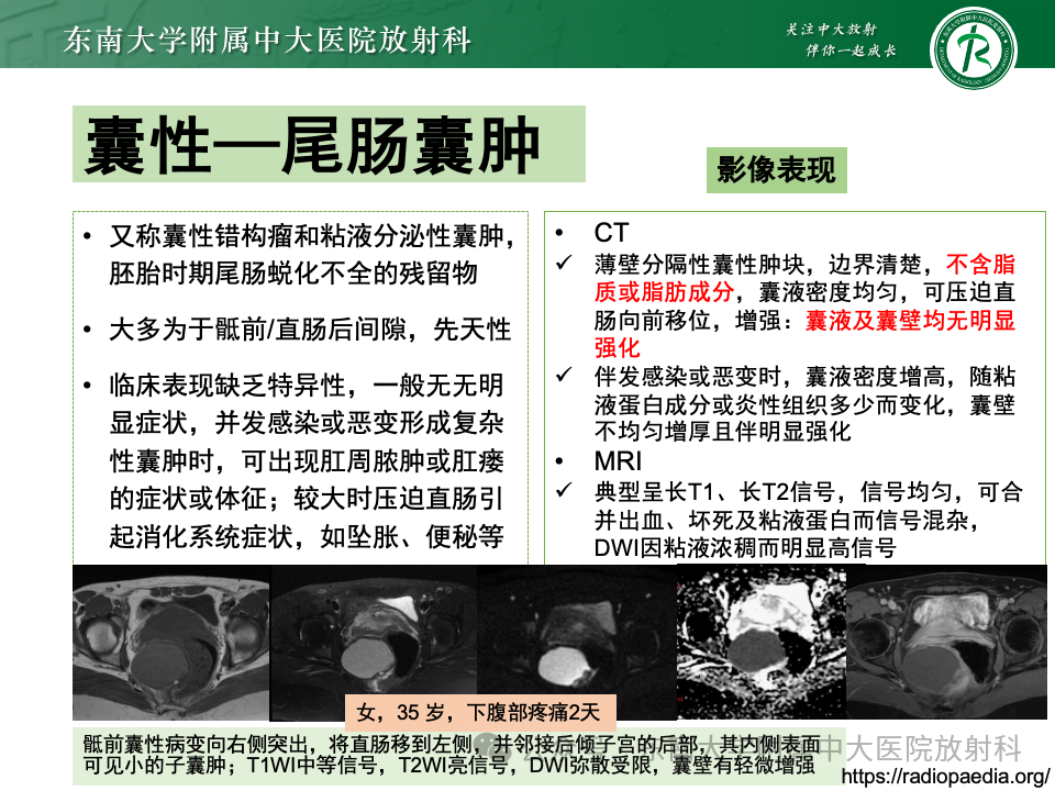 影像PPT - 【PPT】女性盆腔内腹膜外占位性病变-25
