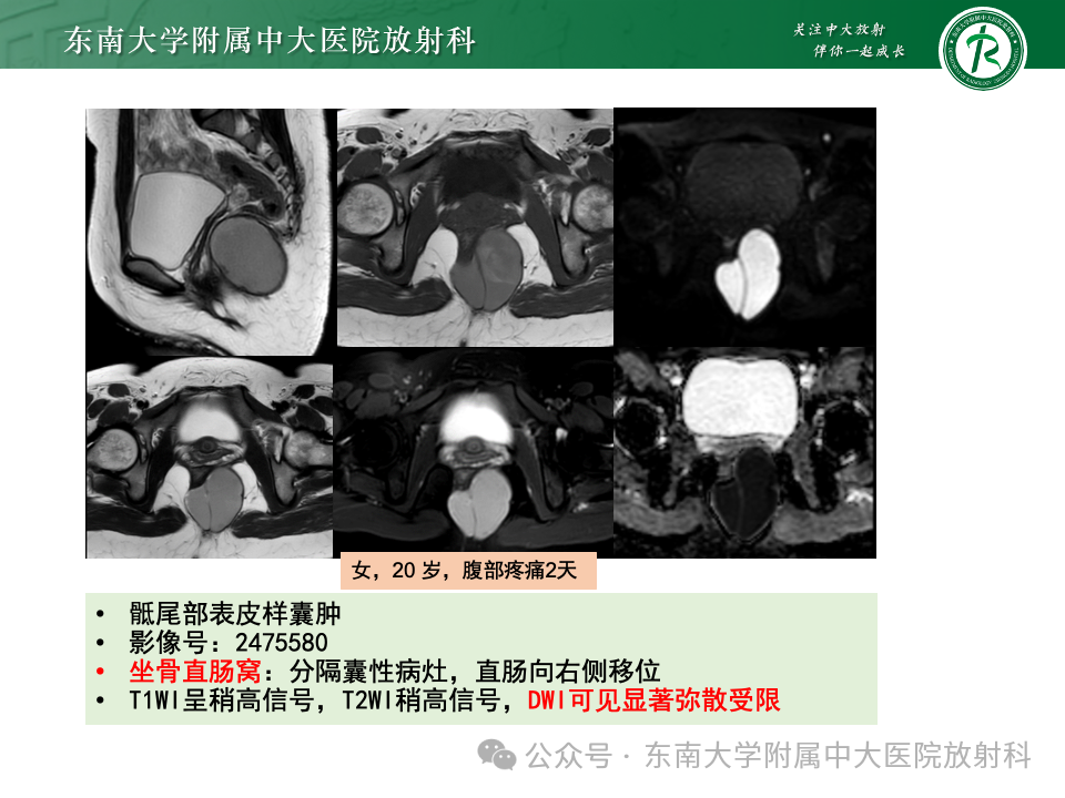影像PPT - 【PPT】女性盆腔内腹膜外占位性病变-27