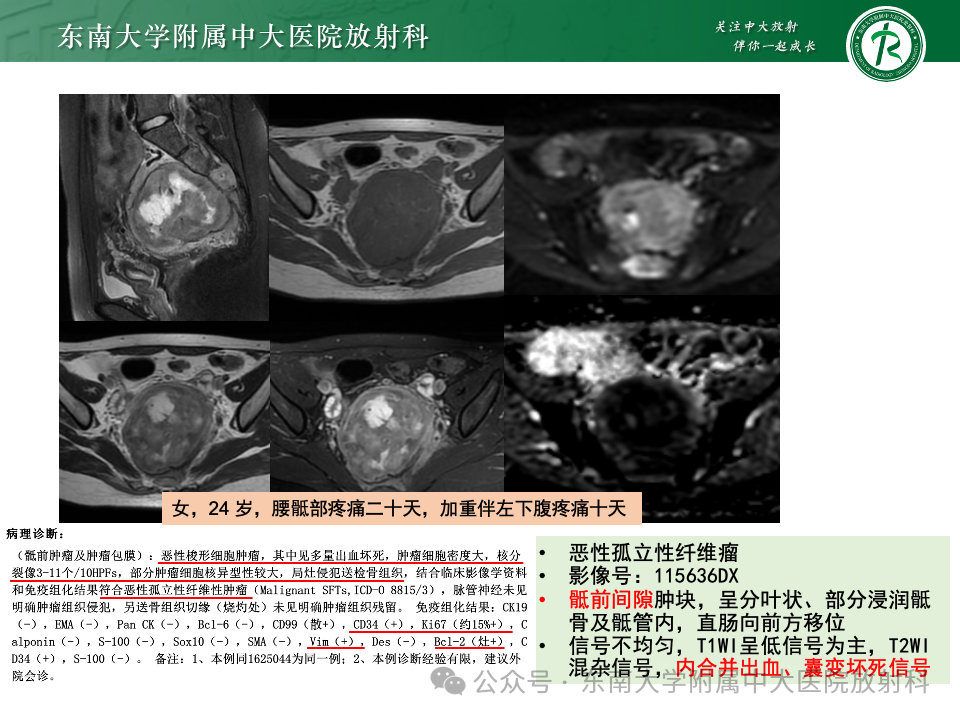 影像PPT - 【PPT】女性盆腔内腹膜外占位性病变-29