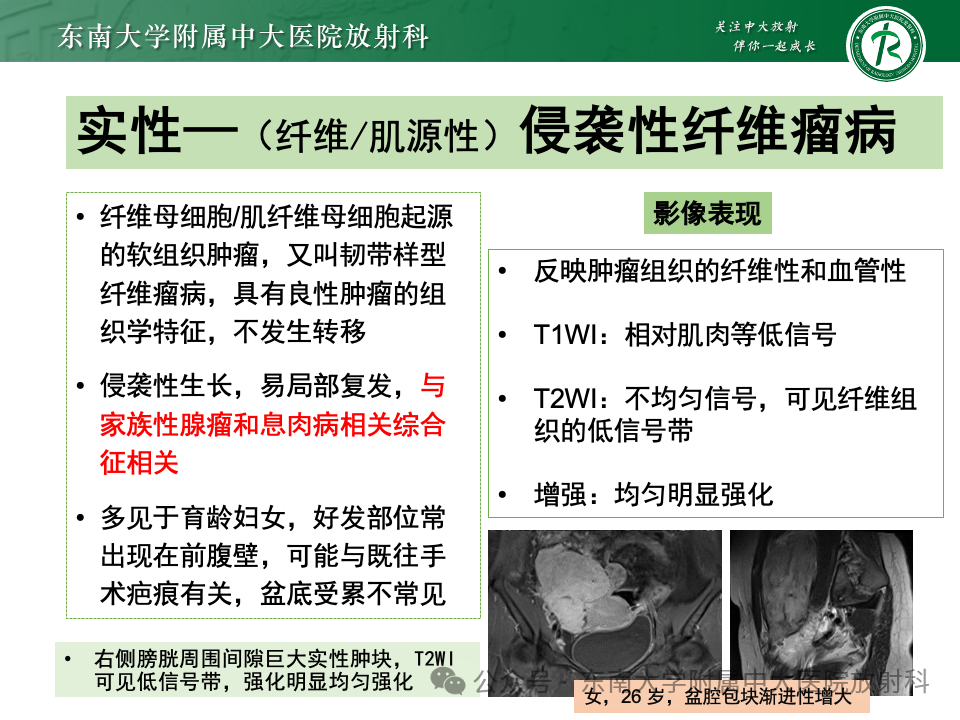 影像PPT - 【PPT】女性盆腔内腹膜外占位性病变-30