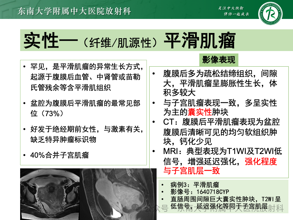 影像PPT - 【PPT】女性盆腔内腹膜外占位性病变-31