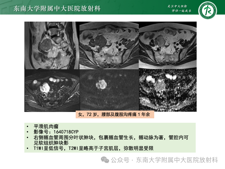 影像PPT - 【PPT】女性盆腔内腹膜外占位性病变-33