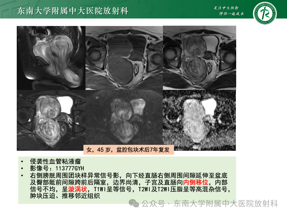 影像PPT - 【PPT】女性盆腔内腹膜外占位性病变-35