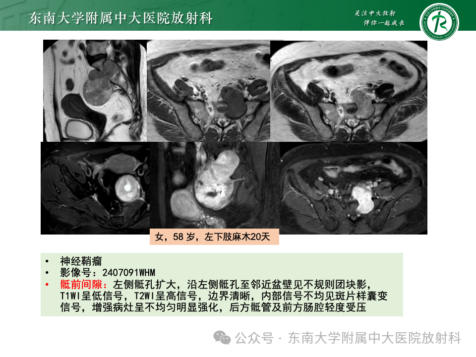影像PPT - 【PPT】女性盆腔内腹膜外占位性病变-37