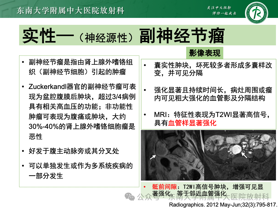 影像PPT - 【PPT】女性盆腔内腹膜外占位性病变-38